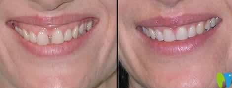 門(mén)牙中間有縫矯正前后對(duì)比圖