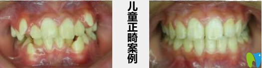 成都君臣兒童正畸案例及前后對(duì)比照