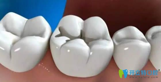 樹脂補牙能用多久