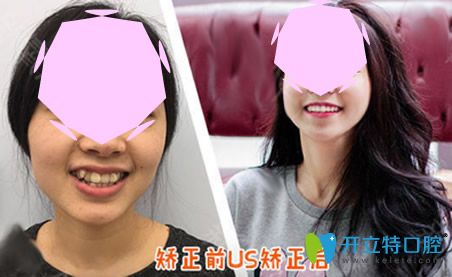 成都?xì)g悅口腔隱形矯正術(shù)前術(shù)后對比案例