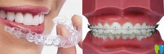 活動(dòng)矯正器和固定矯正器有什么區(qū)別
