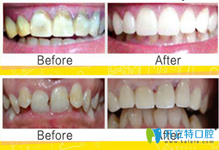 黃圣奇3D瓷?？萄例X修復真人案例