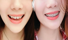 奉上我在成都歡悅口腔戴鋼絲牙套1-4個月臉型變化圖及感受