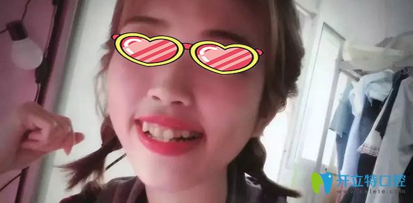 <!--<i data=20240703-sp></i>-->口腔金屬托槽矯正牙齒前 <!--<i data=20240703-sp></i>-->口腔金屬托槽矯正牙齒前