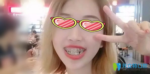 戴牙套矯正牙齒6個(gè)月恢復(fù)效果 戴牙套矯正牙齒6個(gè)月恢復(fù)效果