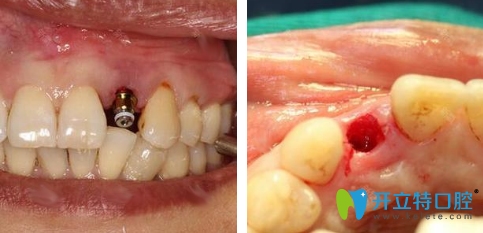 羅維明拔牙兼種植牙手術(shù)過程