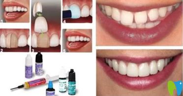 樹脂貼面相對(duì)來說價(jià)格稍低