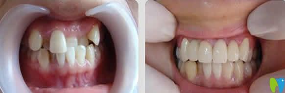 嘉悅口腔牙齒矯正前后對比圖 嘉悅口腔牙齒矯正前后對比圖