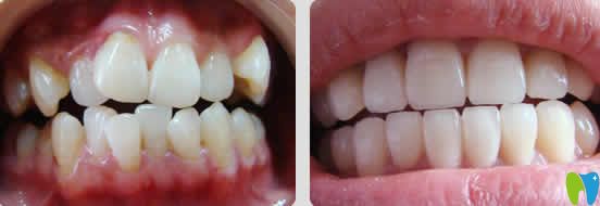 重慶嘉悅口腔周繼祥正畸案例效果圖 重慶嘉悅口腔周繼祥正畸案例效果圖