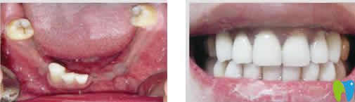 蘭州惠安齒科冉俊杰種植牙案例效果圖