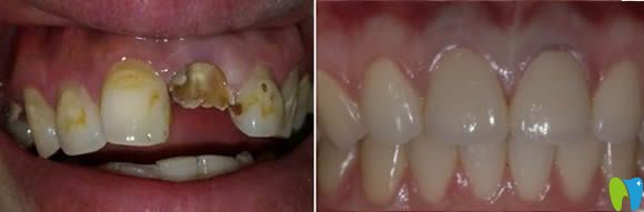 大連昭鶴口腔李文顏牙齒修復效果圖