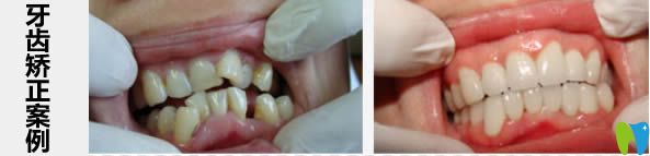 長沙愛思特口腔成人牙齒矯正案例 長沙愛思特口腔成人牙齒矯正案例
