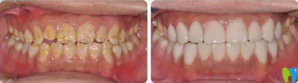 愛思特超薄瓷貼面修復(fù)案例及對比圖 愛思特超薄瓷貼面修復(fù)案例及對比圖