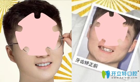去珠海愛思特口腔做牙齒不齊、個(gè)別反頜矯正案例對比圖