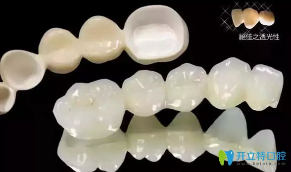 全瓷牙不含金屬內冠透光性好