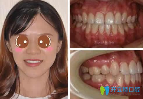 我在蘭州惠安齒科做隱形矯正一年的效果 我在蘭州惠安齒科做隱形矯正一年的效果