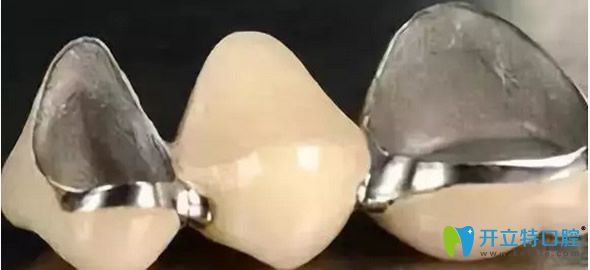烤瓷牙是瓷粉熔附于金屬內冠的修復體