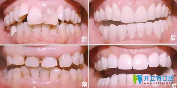 全瓷牙美容修復效果案例
