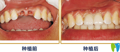 重慶種植牙哪家好？來看牙衛(wèi)士口腔種植牙案例效果