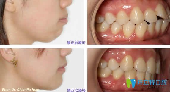 ?？趪趴谇环鶓c醫(yī)生隱形牙齒矯正案例效果圖