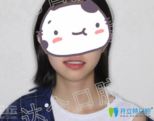 戴半隱形陶瓷牙套12個(gè)月后的矯正效果