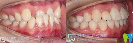 崔南個別牙齒反頜矯正案例前后效果對比圖