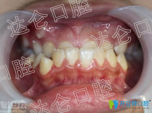 做牙齒矯正前的近照