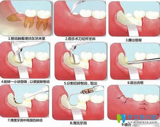 拔智慧牙過程圖
