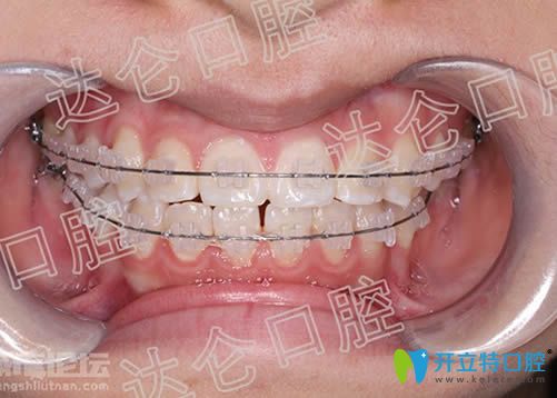 在<!--<i data=20240703-sp></i>-->口腔做地包天矯正29個(gè)月后的近照