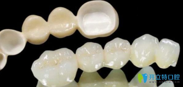 全瓷冠比烤瓷冠價格貴