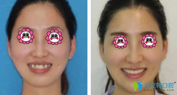 ?？趪趴谇换⒀莱C正前后對比圖