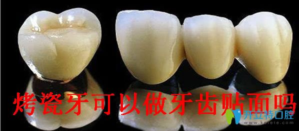 烤瓷牙可以做牙齒貼面嗎