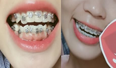 記錄我5個月來在武漢第一口腔醫(yī)院做牙齒正畸的體驗(yàn)，附圖