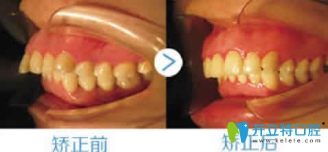 寧波協(xié)禾口腔呂棟主任齙牙矯正真人案例效果