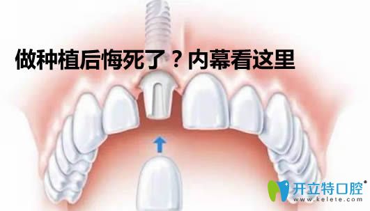 做了種植牙后悔死了?來看做過種植牙的人談體會(huì)與個(gè)人經(jīng)歷