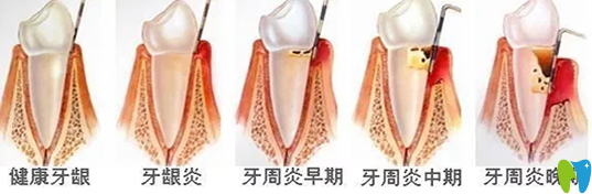 牙齦炎和牙周炎的區(qū)別有哪些