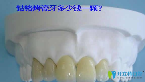 鈷鉻烤瓷牙的價格