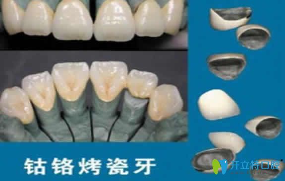 鈷鉻烤瓷牙能用多少年