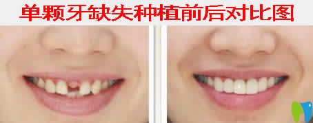 南昌輝煌口腔白彭院長種植牙案例效果圖 南昌輝煌口腔白彭院長種植牙案例效果圖