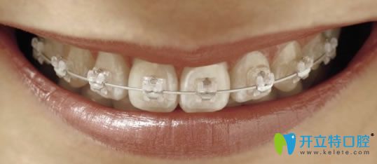 陶瓷托槽矯正器圖示