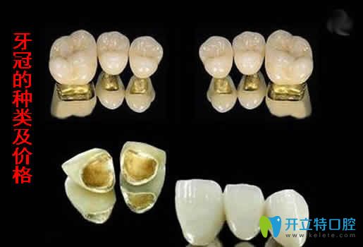 牙冠的種類及價格