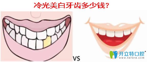 冷光美白牙齒多少錢(qián)