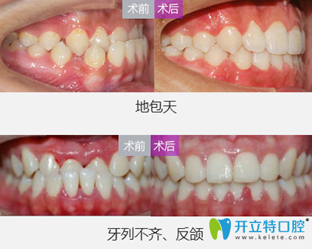 美萊口腔院長(zhǎng)地包天矯正+牙列不齊、反頜矯正案例