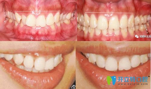 <!--<i data=20240703-sp></i>-->美萊口腔隱形矯正牙齒前后對比圖