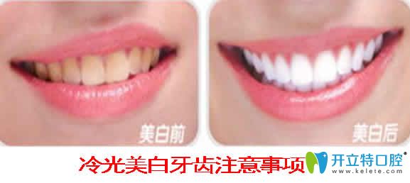冷光美白牙齒注意事項(xiàng)