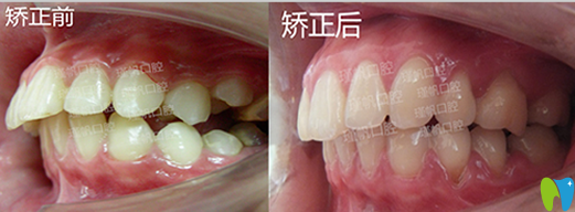 桂林瑾帆口腔好不好？真人牙齒矯正案例及術(shù)后反饋來(lái)驗(yàn)證