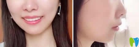 我在武漢優(yōu)益佳口腔做牙齒矯正15個月效果 我在武漢優(yōu)益佳口腔做牙齒矯正15個月效果