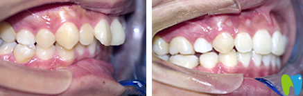 斯美爾口腔隱形矯正前后對比圖 斯美爾口腔隱形矯正前后對比圖