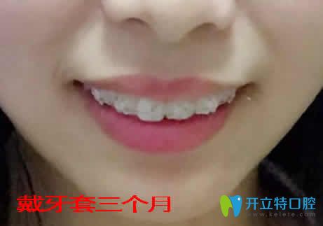 我在武漢優(yōu)益佳口腔做深覆合矯正三個月照片 我在武漢優(yōu)益佳口腔做深覆合矯正三個月照片