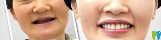 中山維爾口腔60歲老人全口種植牙案例對比圖